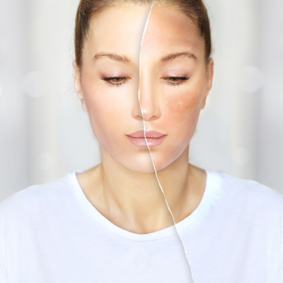 Descubre el Poder del Ácido Tranexámico en tu Rutina de Skincare