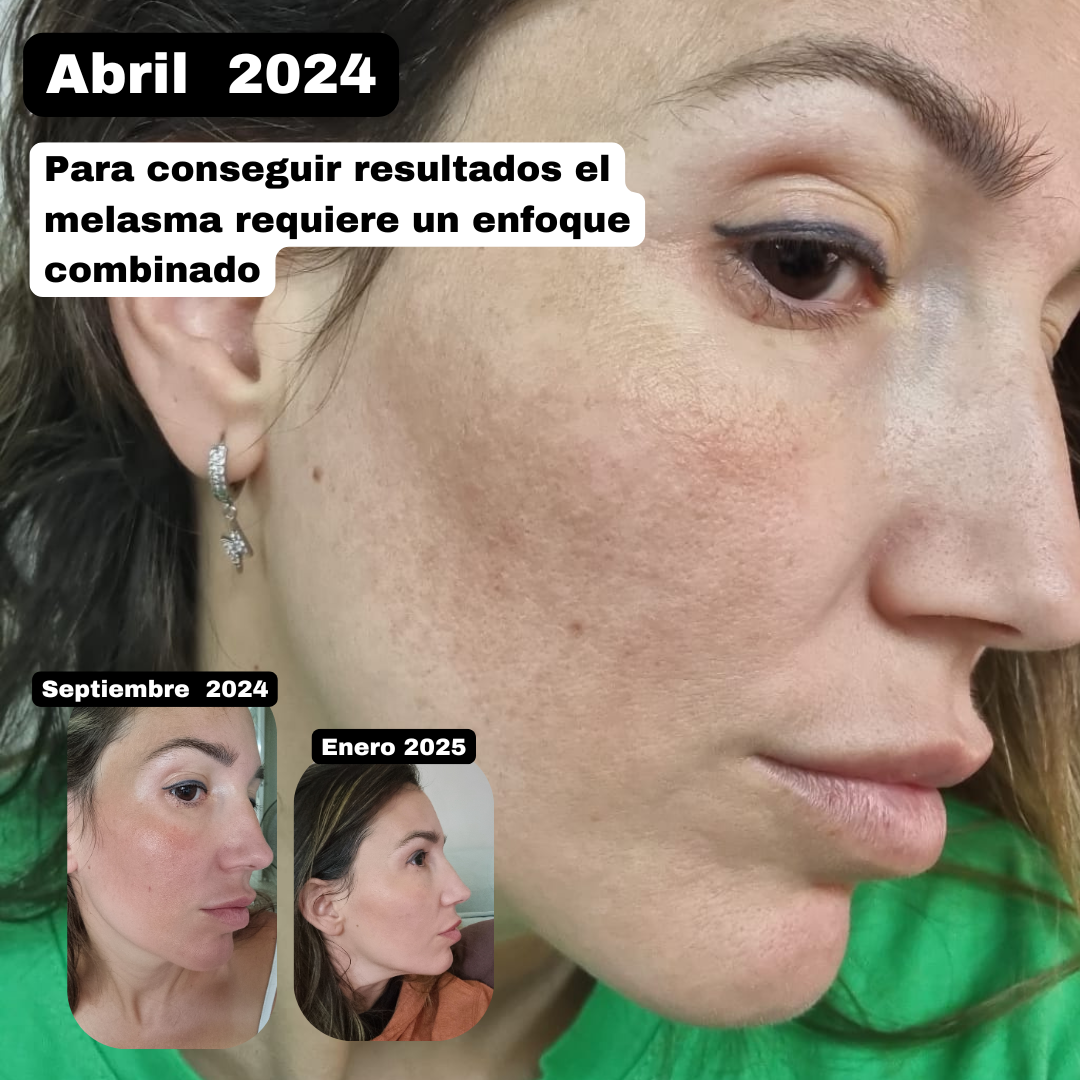 RUTINA MELASMA